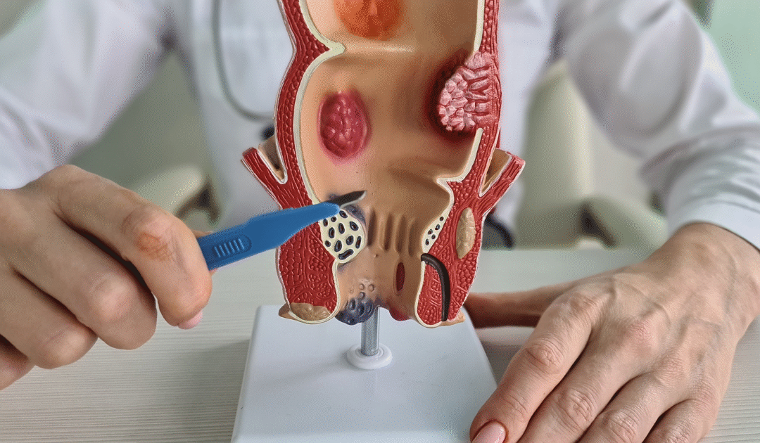 Understanding Proctology: Addressing Common Anorectal Disorders