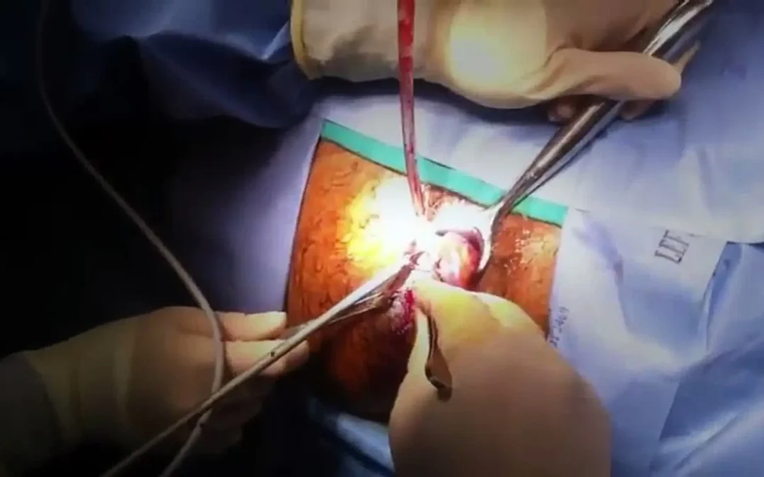 laser piles treatment