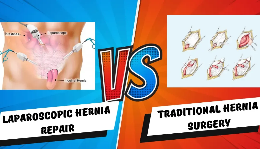 Laparoscopic Hernia Repair vs Traditional Hernia Surgery — Pros & Cons